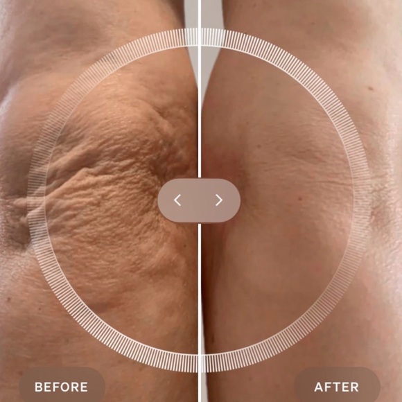 TWO! LYMA LASERS - Picture 8 of 8